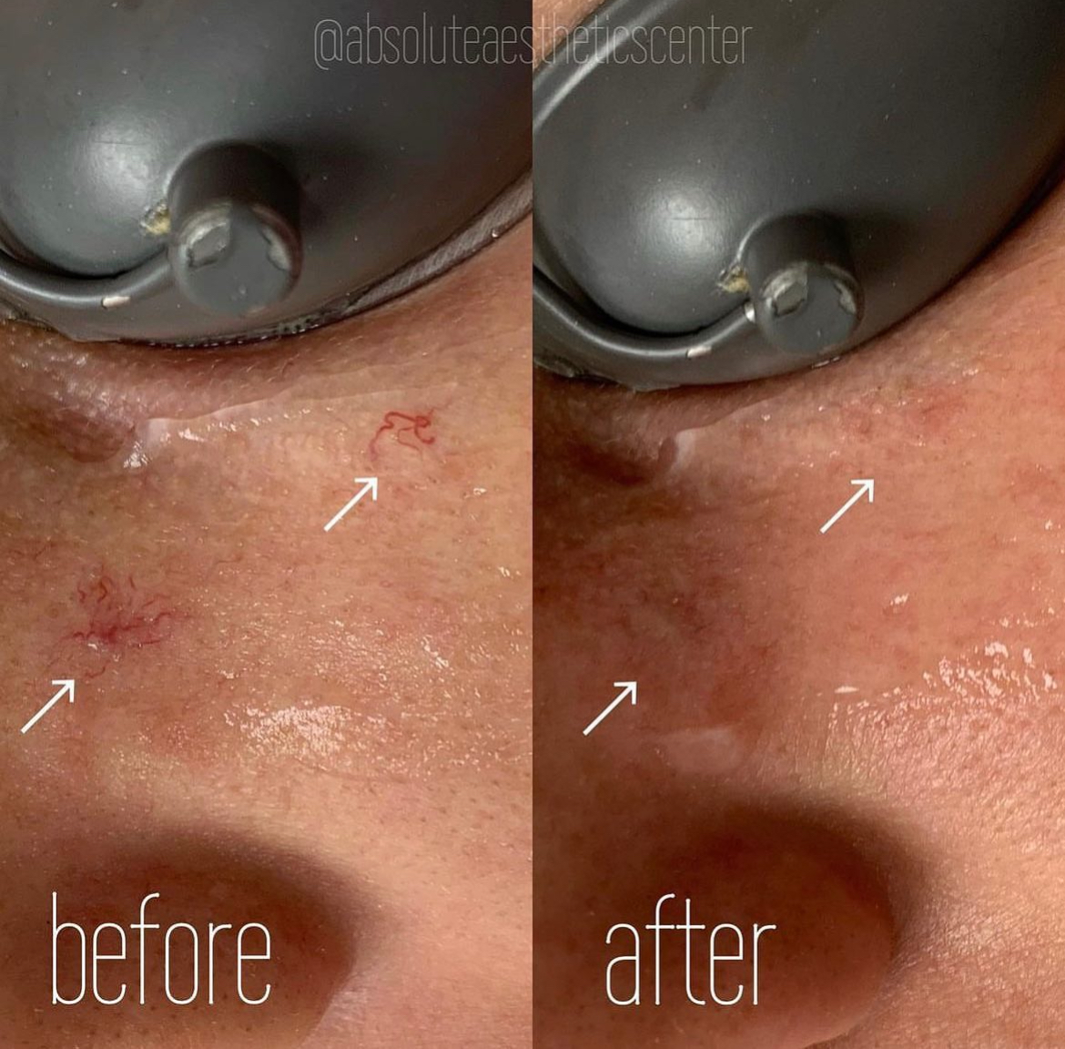 Before and After Image: YAG Capillaries - front