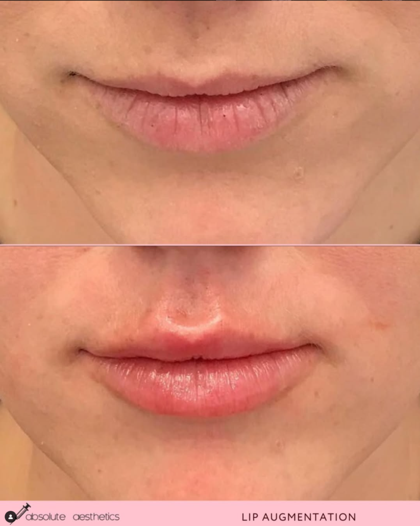 beforeandafter juvederm lip filler