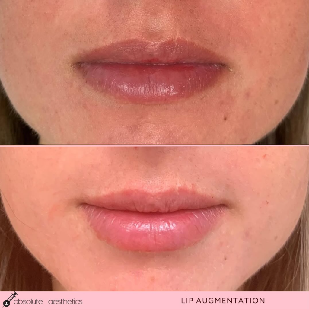 beforeandafter juvederm lip filler2